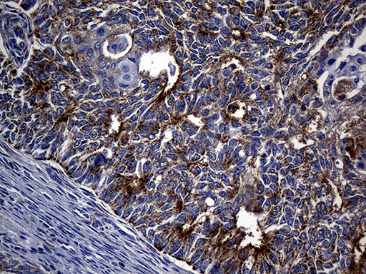 TIM23 Antibody - Immunohistochemical staining of paraffin-embedded Adenocarcinoma of Human endometrium tissue using anti-TIMM23 mouse monoclonal antibody. (Heat-induced epitope retrieval by 1mM EDTA in 10mM Tris buffer. (pH8.5) at 120°C for 3 min. (1:2000)