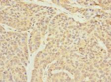 TIM23 Antibody - Immunohistochemistry of paraffin-embedded human ovarian cancer at dilution 1:100