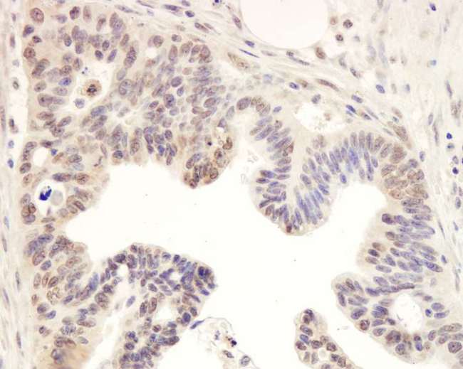 TIMELESS Antibody - Detection of Human Timeless by Immunohistochemistry. Sample: FFPE section of human ovarian carcinoma. Antibody: Affinity purified rabbit anti-Timeless used at a dilution of 1:1000 (1 ug/ml). Detection: DAB.