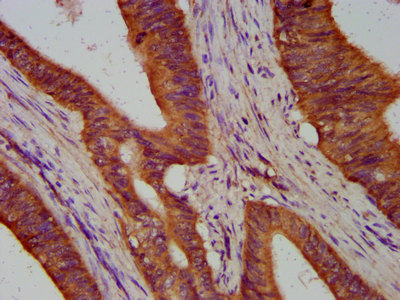 TIMELESS Antibody - Immunohistochemistry image at a dilution of 1:300 and staining in paraffin-embedded human colon cancer performed on a Leica BondTM system. After dewaxing and hydration, antigen retrieval was mediated by high pressure in a citrate buffer (pH 6.0) . Section was blocked with 10% normal goat serum 30min at RT. Then primary antibody (1% BSA) was incubated at 4 °C overnight. The primary is detected by a biotinylated secondary antibody and visualized using an HRP conjugated SP system.