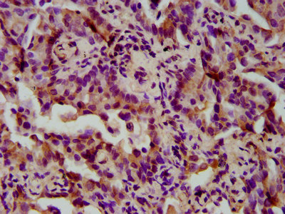 TIMELESS Antibody - Immunohistochemistry image at a dilution of 1:300 and staining in paraffin-embedded human lung cancer performed on a Leica BondTM system. After dewaxing and hydration, antigen retrieval was mediated by high pressure in a citrate buffer (pH 6.0) . Section was blocked with 10% normal goat serum 30min at RT. Then primary antibody (1% BSA) was incubated at 4 °C overnight. The primary is detected by a biotinylated secondary antibody and visualized using an HRP conjugated SP system.