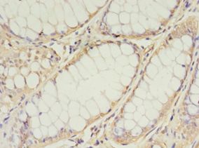 TIMM10 Antibody - Immunohistochemistry of paraffin-embedded human colon cancer using antibody at 1:100 dilution.  This image was taken for the unconjugated form of this product. Other forms have not been tested.