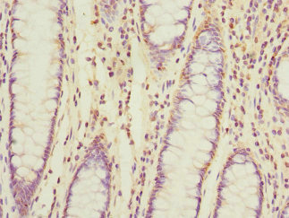 TIMM17A / TIM17 Antibody - Immunohistochemistry of paraffin-embedded human colon cancer at dilution 1:100