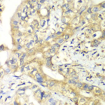 TIMM17A / TIM17 Antibody - Immunohistochemistry of paraffin-embedded human liver cancer using TIMM17A antibody at dilution of 1:100 (40x lens).