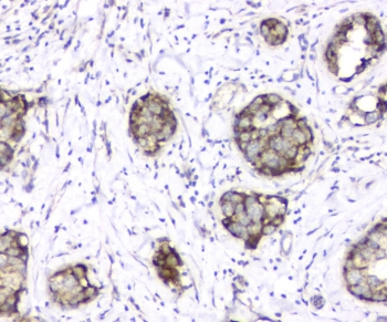TIMM17A / TIM17 Antibody - IHC staining of FFPE human breast cancer with TIMM17A antibody at 1ug/ml. HIER: boil tissue sections in pH6, 10mM citrate buffer, for 10-20 min and allow to cool before testing.