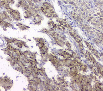 TIMM17A / TIM17 Antibody - IHC staining of FFPE human liver cancer with TIMM17A antibody at 1ug/ml. HIER: boil tissue sections in pH6, 10mM citrate buffer, for 10-20 min and allow to cool before testing.