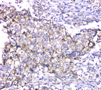 TIMM17A / TIM17 Antibody - IHC staining of FFPE human lung cancer with TIMM17A antibody at 1ug/ml. HIER: boil tissue sections in pH6, 10mM citrate buffer, for 10-20 min and allow to cool before testing.