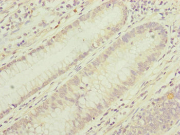TIMM17B Antibody - Immunohistochemistry of paraffin-embedded human colon cancer at dilution of 1:100