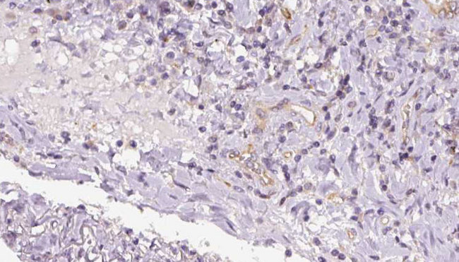 TIMM17B Antibody - 1:100 staining human lymph carcinoma tissue by IHC-P. The sample was formaldehyde fixed and a heat mediated antigen retrieval step in citrate buffer was performed. The sample was then blocked and incubated with the antibody for 1.5 hours at 22°C. An HRP conjugated goat anti-rabbit antibody was used as the secondary.