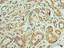 TIMM21 Antibody - Immunohistochemistry of paraffin-embedded human breast cancer using antibody at 1:100 dilution.