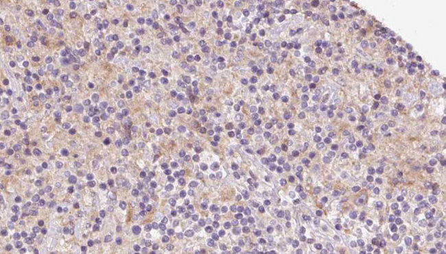 TIMM22 Antibody - 1:100 staining human lymph carcinoma tissue by IHC-P. The sample was formaldehyde fixed and a heat mediated antigen retrieval step in citrate buffer was performed. The sample was then blocked and incubated with the antibody for 1.5 hours at 22°C. An HRP conjugated goat anti-rabbit antibody was used as the secondary.