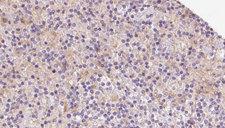 TIMM22 Antibody - 1:100 staining human lymph carcinoma tissue by IHC-P. The sample was formaldehyde fixed and a heat mediated antigen retrieval step in citrate buffer was performed. The sample was then blocked and incubated with the antibody for 1.5 hours at 22°C. An HRP conjugated goat anti-rabbit antibody was used as the secondary.