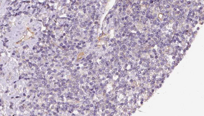 TIMM44 / TIM44 Antibody - 1:100 staining human lymph carcinoma tissue by IHC-P. The sample was formaldehyde fixed and a heat mediated antigen retrieval step in citrate buffer was performed. The sample was then blocked and incubated with the antibody for 1.5 hours at 22°C. An HRP conjugated goat anti-rabbit antibody was used as the secondary.