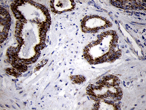TIMM8A Antibody - Immunohistochemical staining of paraffin-embedded Carcinoma of Human prostate tissue using anti-TIMM8A mouse monoclonal antibody. (Heat-induced epitope retrieval by 1mM EDTA in 10mM Tris buffer. (pH8.5) at 120°C for 3 min. (1:500)