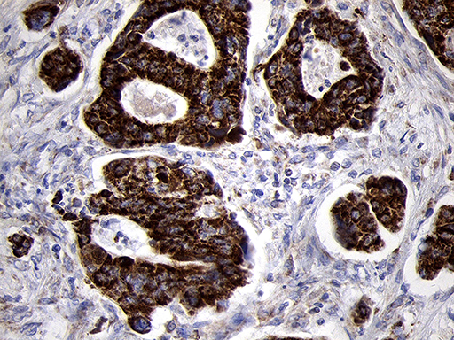 TIMM8A Antibody - Immunohistochemical staining of paraffin-embedded Adenocarcinoma of Human colon tissue using anti-TIMM8A mouse monoclonal antibody. (Heat-induced epitope retrieval by 1mM EDTA in 10mM Tris buffer. (pH8.5) at 120°C for 3 min. (1:500)