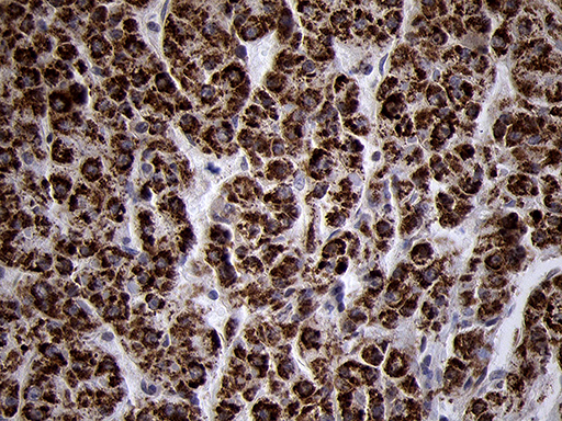 TIMM8A Antibody - Immunohistochemical staining of paraffin-embedded Human liver tissue within the normal limits using anti-TIMM8A mouse monoclonal antibody. (Heat-induced epitope retrieval by 1mM EDTA in 10mM Tris buffer. (pH8.5) at 120°C for 3 min. (1:500)