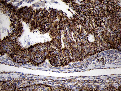 TIMM8A Antibody - Immunohistochemical staining of paraffin-embedded Adenocarcinoma of Human endometrium tissue using anti-TIMM8A mouse monoclonal antibody. (Heat-induced epitope retrieval by 1mM EDTA in 10mM Tris buffer. (pH8.5) at 120°C for 3 min. (1:500)