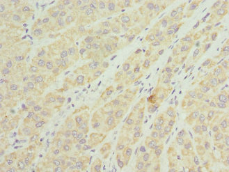 TIMM8A Antibody - Immunohistochemistry of paraffin-embedded human liver cancer tissue at dilution 1:100