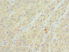 TIMM8A Antibody - Immunohistochemistry of paraffin-embedded human liver cancer tissue at dilution 1:100