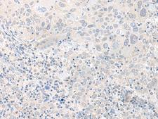 TIMM8A Antibody - Immunohistochemistry of paraffin-embedded Human cervical cancer tissue  using TIMM8A Polyclonal Antibody at dilution of 1:50(×200)