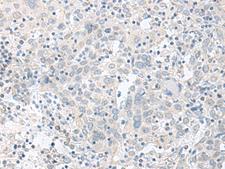 TIMM8A Antibody - Immunohistochemistry of paraffin-embedded Human cervical cancer tissue  using TIMM8A Polyclonal Antibody at dilution of 1:90(×200)