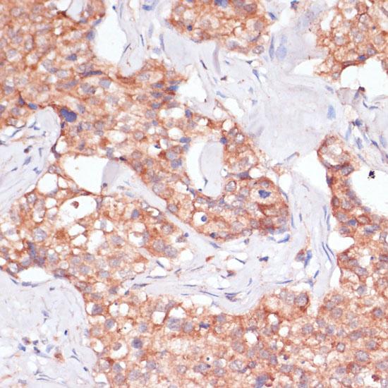 TIMM8B Antibody - Immunohistochemistry of paraffin-embedded Human breast cancer using TIMM8B Polyclonal Antibody at dilution of 1:100 (40x lens).