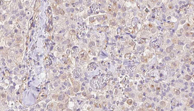 TIMM9 Antibody - 1:100 staining human thyroid carcinoma tissue by IHC-P. The sample was formaldehyde fixed and a heat mediated antigen retrieval step in citrate buffer was performed. The sample was then blocked and incubated with the antibody for 1.5 hours at 22°C. An HRP conjugated goat anti-rabbit antibody was used as the secondary.