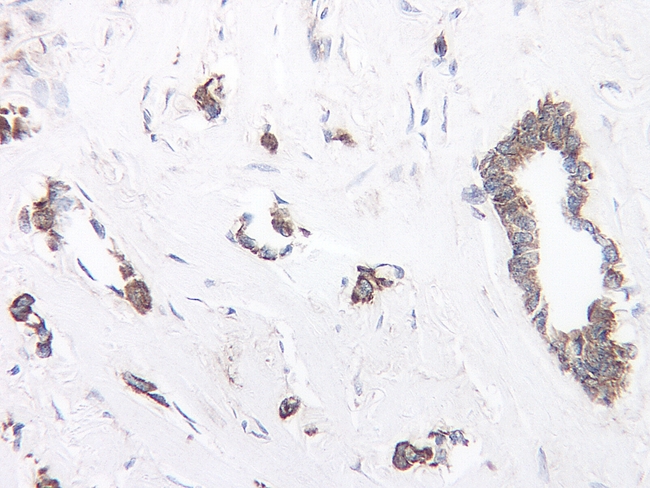 TIMP1 Antibody - Immunohistochemistry of formalin-fixed, paraffin-embedded human breast invasive ductal carcinoma stained with Rabbit anti-Human TIMP-1 following enzyme mediated antigen retrieval using proteinase K