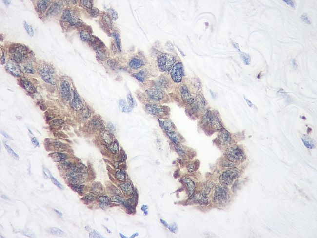 TIMP1 Antibody - Immunohistochemistry of formalin-fixed, paraffin-embedded human breast invasive ductal carcinoma stained with Rabbit anti-Human TIMP-1 following enzyme mediated antigen retrieval using proteinase K