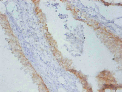TIMP1 Antibody - Immunohistochemistry of paraffin-embedded Rat prostate cancer using Timp1 Monoclonal Antibody at dilution of 1:100.