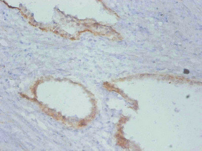 TIMP1 Antibody - Immunohistochemistry of paraffin-embedded human prostate cancer using TIMP1 Monoclonal Antibody at dilution of 1:100