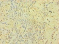 TIMP1 Antibody - Immunohistochemistry of paraffin-embedded human breast cancer at dilution 1:100