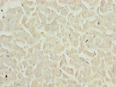 TIMP1 Antibody - Immunohistochemistry of paraffin-embedded human breast cancer using TIMP1 Antibody at dilution of 1:100
