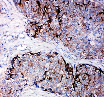 TIMP2 Antibody - IHC-P: TIMP2 antibody testing of human breast cancer tissue
