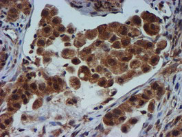 TIMP2 Antibody - IHC of paraffin-embedded Carcinoma of Human lung tissue using anti-TIMP2 mouse monoclonal antibody.
