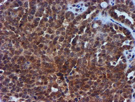 TIMP2 Antibody - IHC of paraffin-embedded Adenocarcinoma of Human ovary tissue using anti-TIMP2 mouse monoclonal antibody.