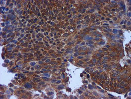 TIMP2 Antibody - IHC of paraffin-embedded Carcinoma of Human bladder tissue using anti-TIMP2 mouse monoclonal antibody.