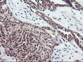 TIMP2 Antibody - IHC of paraffin-embedded Adenocarcinoma of Human ovary tissue using anti-TIMP2 mouse monoclonal antibody. (Heat-induced epitope retrieval by 10mM citric buffer, pH6.0, 100C for 10min).
