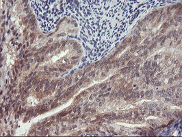 TIMP2 Antibody - IHC of paraffin-embedded Adenocarcinoma of Human endometrium tissue using anti-TIMP2 mouse monoclonal antibody. (Heat-induced epitope retrieval by 10mM citric buffer, pH6.0, 100C for 10min).
