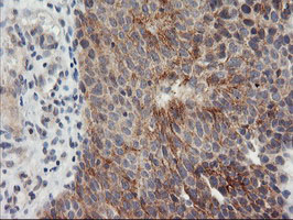 TIMP2 Antibody - IHC of paraffin-embedded Carcinoma of Human bladder tissue using anti-TIMP2 mouse monoclonal antibody.