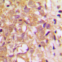 TIMP2 Antibody - Immunohistochemical analysis of TIMP2 staining in human breast cancer formalin fixed paraffin embedded tissue section. The section was pre-treated using heat mediated antigen retrieval with sodium citrate buffer (pH 6.0). The section was then incubated with the antibody at room temperature and detected using an HRP conjugated compact polymer system. DAB was used as the chromogen. The section was then counterstained with hematoxylin and mounted with DPX.