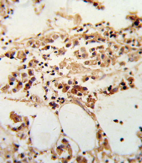 TIMP3 Antibody - Formalin-fixed and paraffin-embedded human breast carcinoma reacted with TIMP3 Antibody , which was peroxidase-conjugated to the secondary antibody, followed by DAB staining. This data demonstrates the use of this antibody for immunohistochemistry; clinical relevance has not been evaluated.