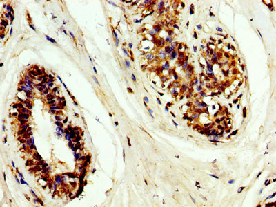 TIMP3 Antibody - Immunohistochemistry image at a dilution of 1:200 and staining in paraffin-embedded human breast cancer performed on a Leica BondTM system. After dewaxing and hydration, antigen retrieval was mediated by high pressure in a citrate buffer (pH 6.0) . Section was blocked with 10% normal goat serum 30min at RT. Then primary antibody (1% BSA) was incubated at 4 °C overnight. The primary is detected by a biotinylated secondary antibody and visualized using an HRP conjugated SP system.