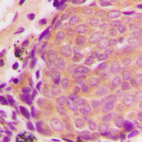 TIMP4 Antibody - Immunohistochemical analysis of TIMP4 staining in human breast cancer formalin fixed paraffin embedded tissue section. The section was pre-treated using heat mediated antigen retrieval with sodium citrate buffer (pH 6.0). The section was then incubated with the antibody at room temperature and detected using an HRP conjugated compact polymer system. DAB was used as the chromogen. The section was then counterstained with hematoxylin and mounted with DPX.