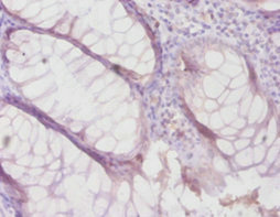 TIMP4 Antibody - Immunohistochemistry of paraffin-embedded human colon cancer using TIMP4 Antibody at dilution of 1:100