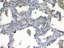 TIMP4 Antibody - IHC testing of FFPE human lung cancer tissue with TIMP4 antibody at 1ug/ml. Required HIER: steam section in pH6 citrate buffer for 20 min and allow to cool prior to testing.
