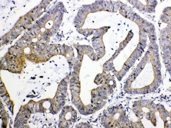 TIMP4 Antibody - IHC testing of FFPE human intestinal cancer tissue with TIMP4 antibody at 1ug/ml. Required HIER: steam section in pH6 citrate buffer for 20 min and allow to cool prior to testing.