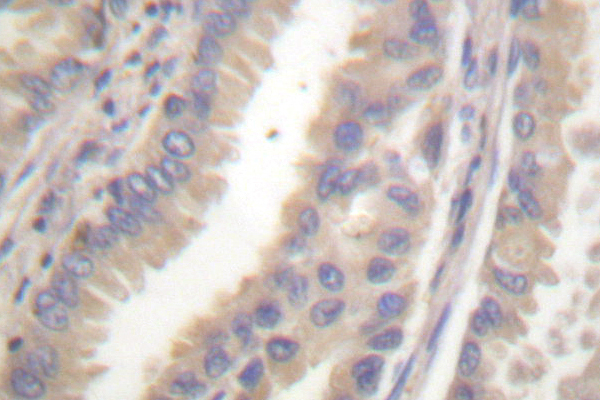TIMP4 Antibody - IHC of TIMP4 (S206) pAb in paraffin-embedded human lung carcinoma tissue.