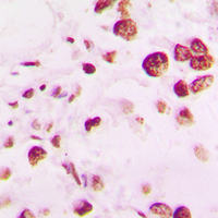 TINF2 Antibody - Immunohistochemical analysis of TIN2 staining in human lung cancer formalin fixed paraffin embedded tissue section. The section was pre-treated using heat mediated antigen retrieval with sodium citrate buffer (pH 6.0). The section was then incubated with the antibody at room temperature and detected using an HRP conjugated compact polymer system. DAB was used as the chromogen. The section was then counterstained with hematoxylin and mounted with DPX.