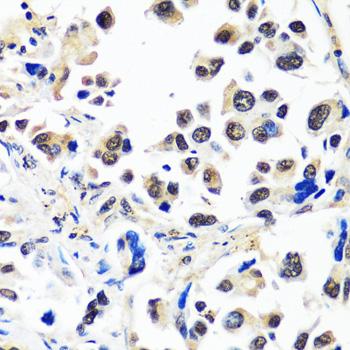 TIP120 / CAND1 Antibody - Immunohistochemistry of paraffin-embedded Human lung cancer using CAND1 Polyclonal Antibody at dilution of 1:100 (40x lens).